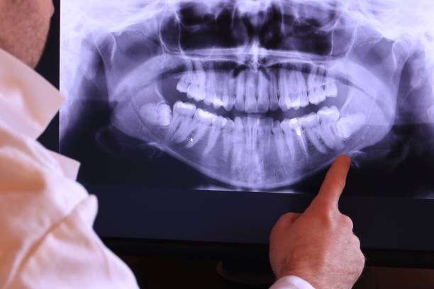 Best Emergency Wisdom Teeth Removal in Alhambra, CA